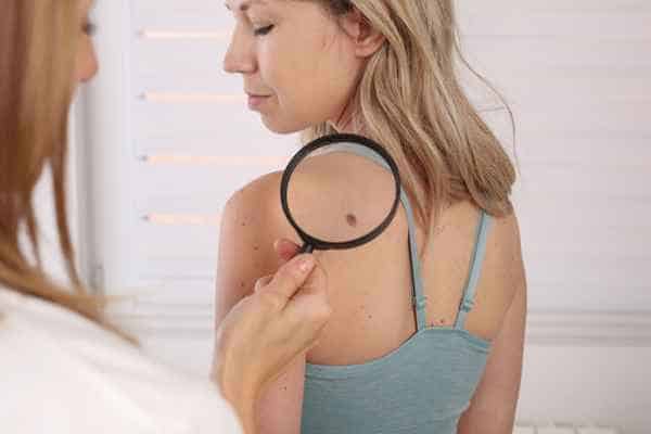 What Are Traditional Skin Lesion Removal Methods Middlewich?