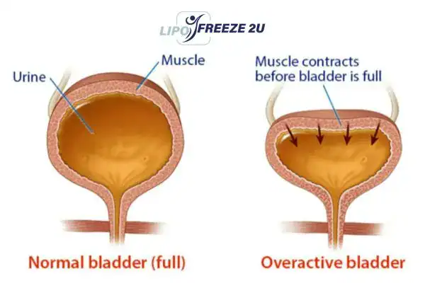 diagram of overactive bladder treatment Middlewich
