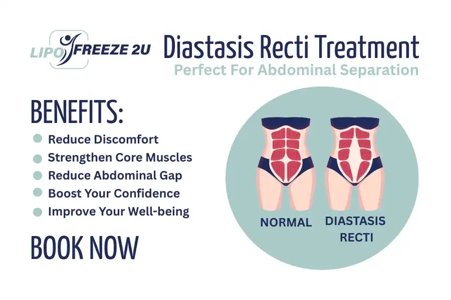 How Long Will It Take to See Improvements in Diastasis Recti Middlewich
