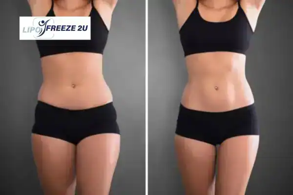How Can LIPO FREEZE 2U Support Your Post-Pregnancy Body Recovery Middlewich?