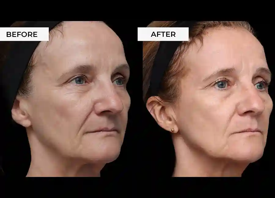 How Many RF Microneedling Sessions Will You Need to See a Difference Middlewich?
