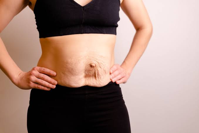 Is Surgery Really the Only Way to Repair Diastasis Recti Middlewich?