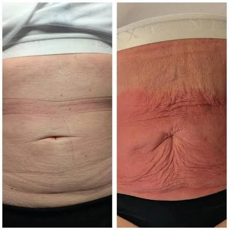 How Does RF Microneedling Improve Crepey, Thin and Uneven Skin Texture Middlewich?