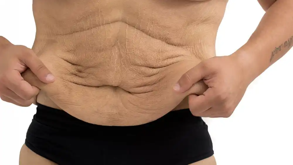 RF Microneedling for Loose Skin: How Can It Help Tighten and Reshape the Skin Middlewich?